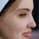 Acne-gel with Сalamine